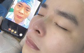 Hình ảnh trước và sau khi Khách hàng căng chỉ 
