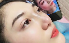 Hình ảnh trước và sau khi Khách hàng căng chỉ 