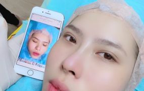 Hình ảnh trước và sau khi Khách hàng căng chỉ 