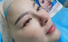 Hình ảnh trước và sau khi Khách hàng căng chỉ 