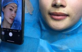 Hình ảnh trước và sau khi Khách hàng căng chỉ 