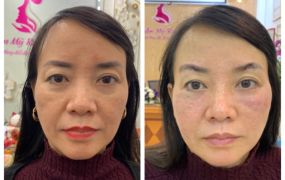 Hình ảnh trước và sau khi Khách hàng căng chỉ 